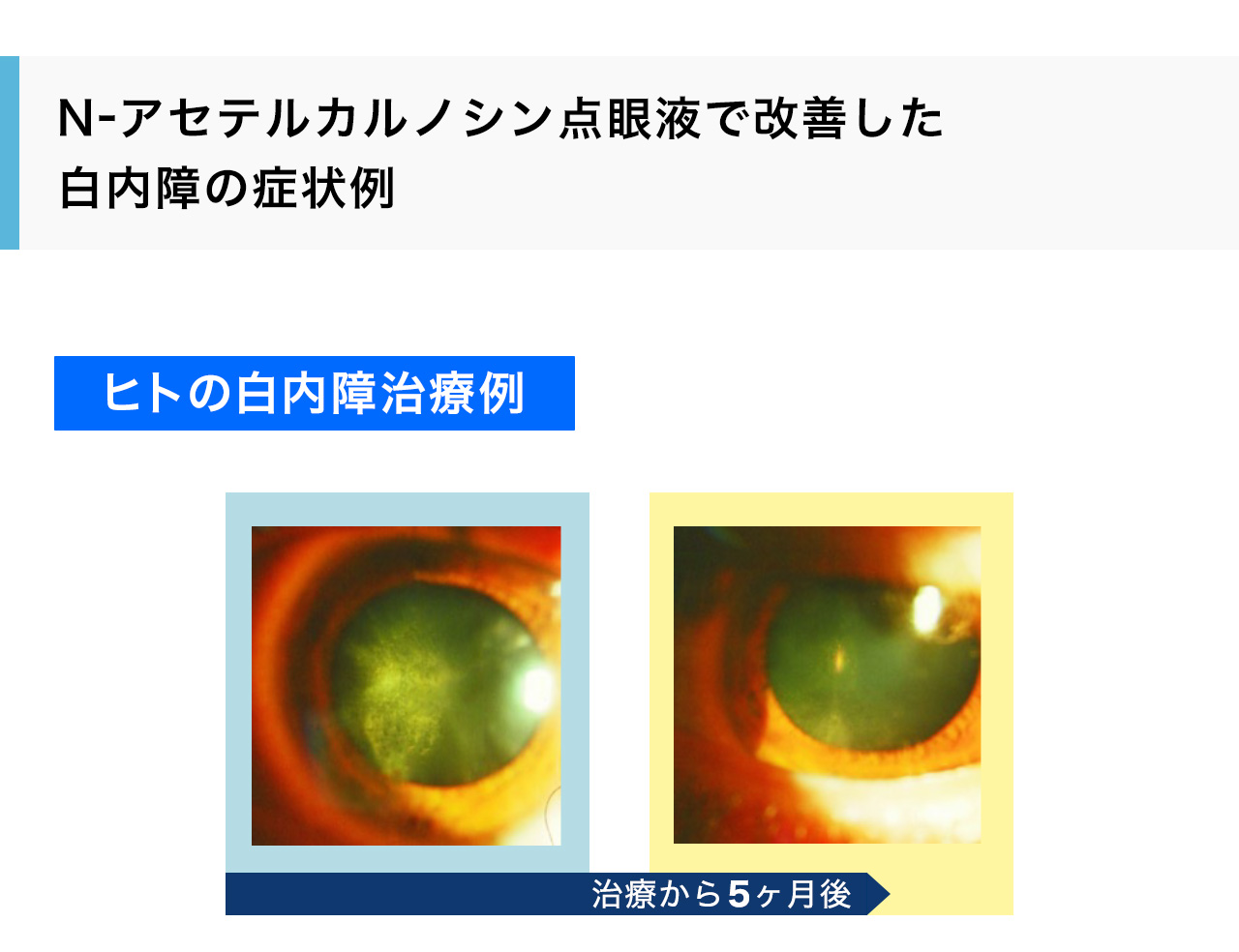 N-アセテルカルノシン点眼液で改善した白内障の症状例