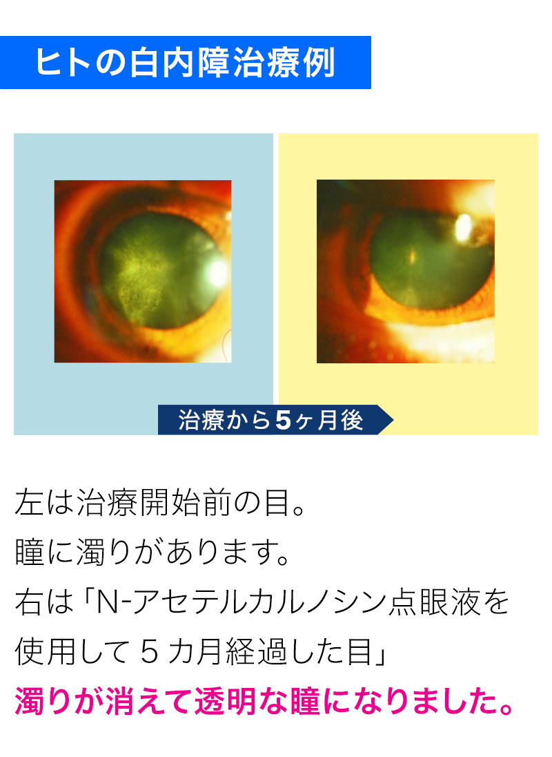 ヒトの白内障治療例。左は治療開始前の目。瞳に濁りがあります。右は「N-アセテルカルノシン点眼液を使用して5カ月経過した目」濁りが消えて透明な瞳になりました。