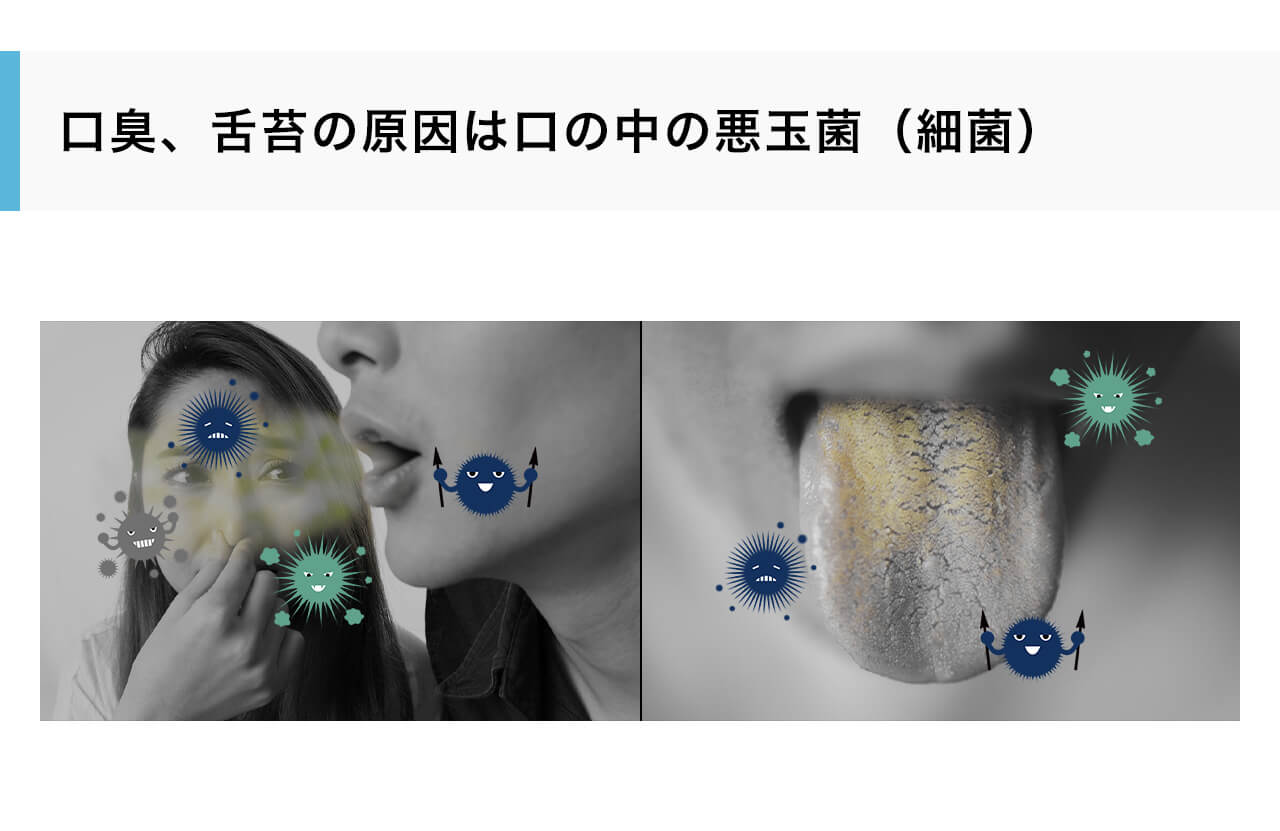 口臭、舌苔の原因は口の中の悪玉菌（細菌）