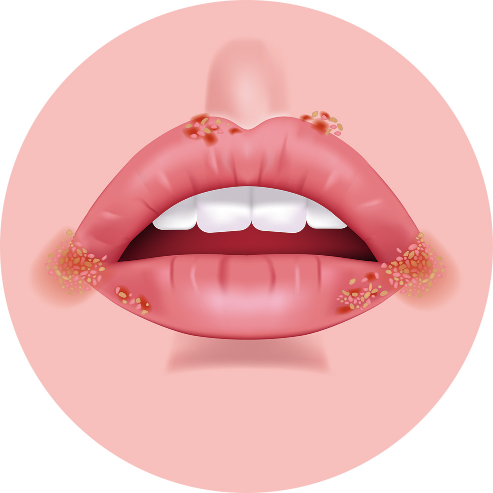 ヘルペスの傷口