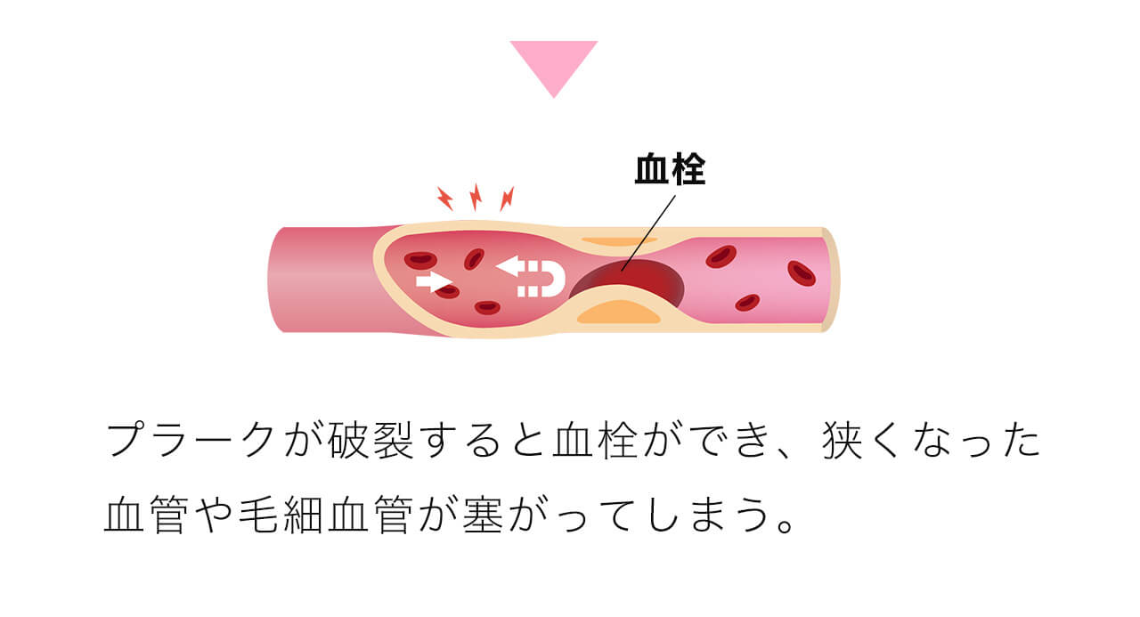 プラークが破裂すると血栓ができ、狭くなった血管や毛細血管が塞がってしまう。
