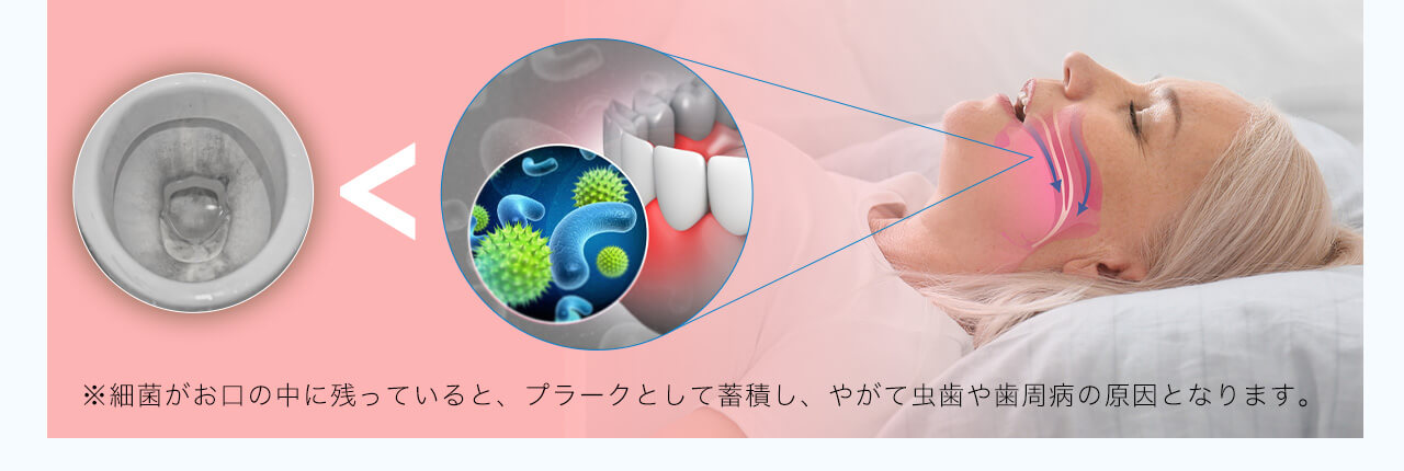 ※細菌がお口の中に残っていると、プラークとして蓄積し、やがて虫歯や歯周病の原因となります。