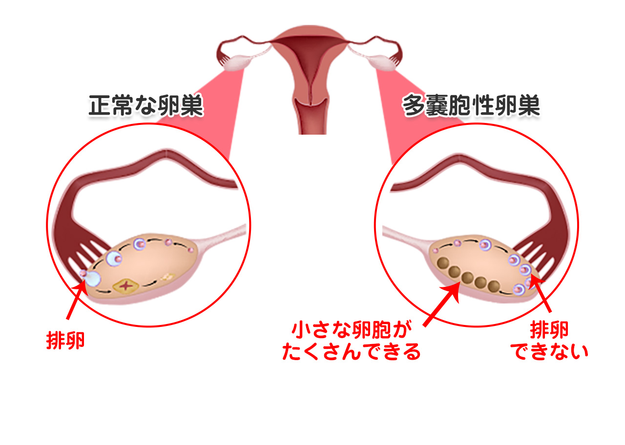 正常な卵巣と多嚢胞性卵巣