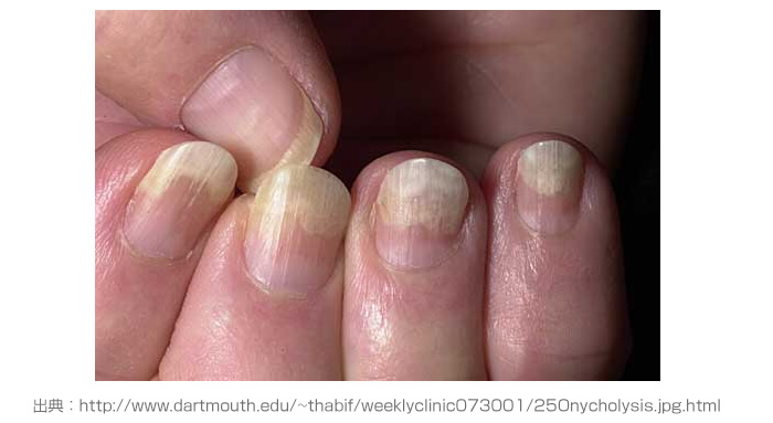 爪甲剥離症の症状は何ですか?